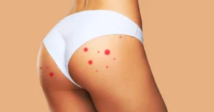 Read more about the article  <strong>Have Pimples on Buttocks? Combat It With These Steps</strong>