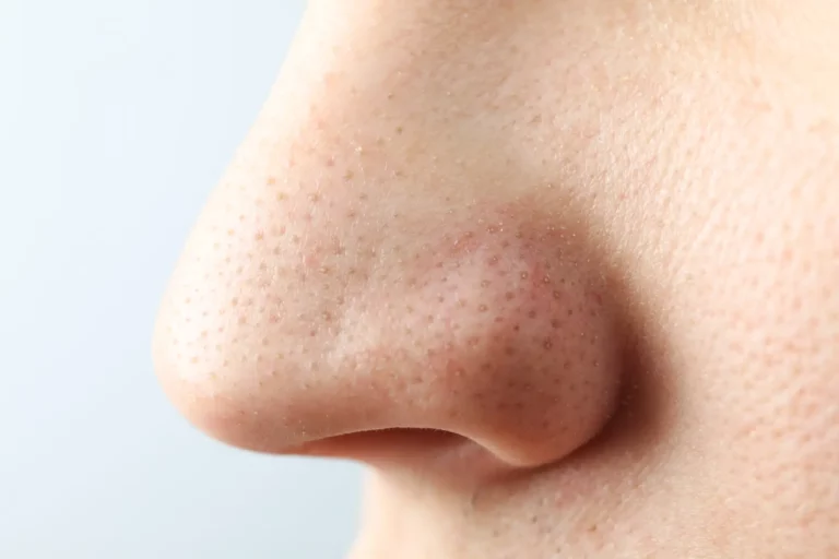 Blackheads: What They Are and How to Combat Them